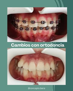 Concepto Bera - ortodoncia