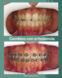 Concepto Bera - tratamiento